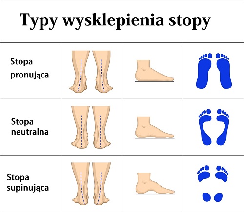 Typy wysklepienia stopy